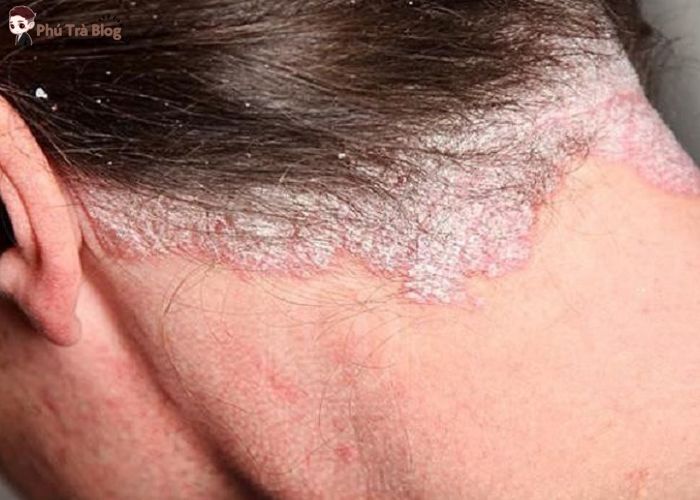 Nguy hại của việc sử dụng dầu gội đầu chứa sunfat đối với tóc và da đầu của bạn